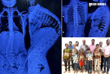 અમદાવાદ સિવિલમાં 7 બાળકોની સાપની જેમ વાંકી વળી ગયેલી કરોડરજ્જુના ઓપરેશન સફળ, નિઃશુલ્ક સર્જરી કરાઈ