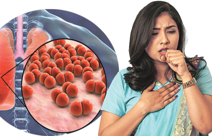 દર્દીને પથારીવશ કરવાને બદલે ચાલતો રાખે વોકિંગ ન્યુમોનિયા 1 - image