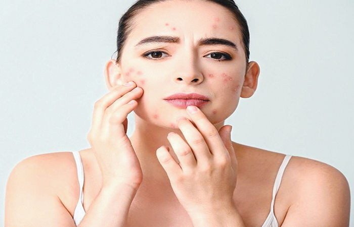 Pimple Protection સૌંદર્યના દુશ્મન સમા ફોડલા-ફોડલીઓથી બચાવ | Protection from pimples ...
