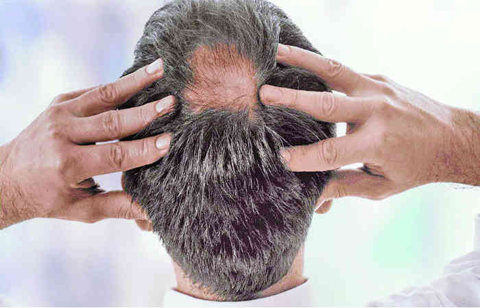 એલોપ્સીયા : સમાધાન આયુર્વેદથી 1 - image