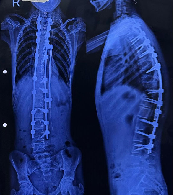 અમદાવાદ સિવિલમાં 7 બાળકોની સાપની જેમ વાંકી વળી ગયેલી કરોડરજ્જુના ઓપરેશન સફળ, નિઃશુલ્ક સર્જરી કરાઈ 2 - image