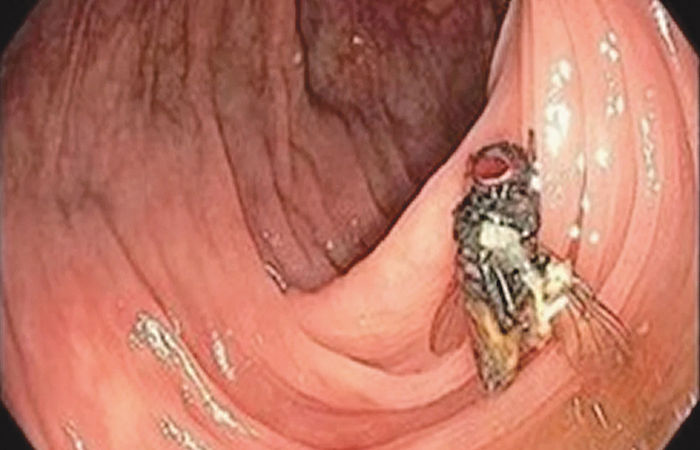 અમેરિકામાં ડોક્ટરોએ 64 વર્ષના દર્દીના આંતરડામાંથી જીવતી માખી કાઢી ! 1 - image