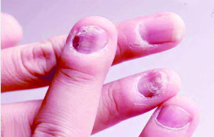 નબળા અને બરડ નખનો કોઈ હાથવગો ઈલાજ ખરો? 1 - image