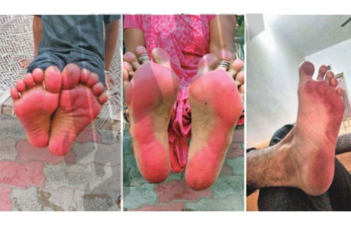 Naroda residents suffer red stained feet due to suspected airborne chemical pollution