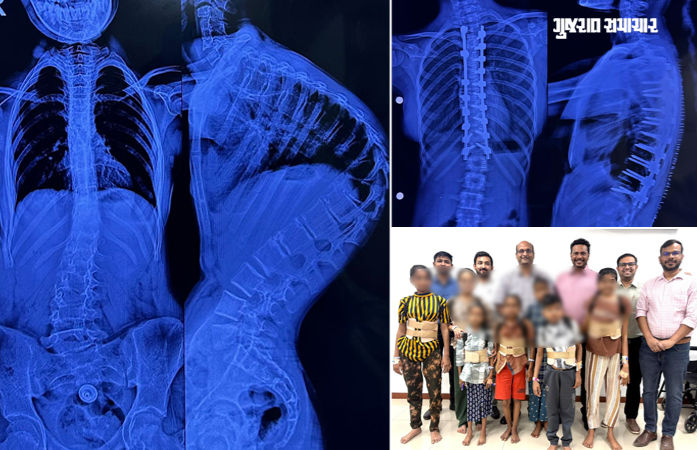 અમદાવાદ સિવિલમાં 7 બાળકોની સાપની જેમ વાંકી વળી ગયેલી કરોડરજ્જુના ઓપરેશન સફળ, નિઃશુલ્ક સર્જરી કરાઈ 1 - image